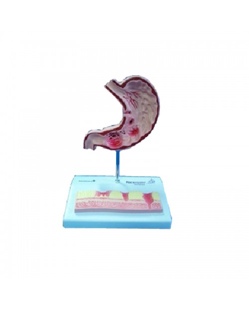 Anatomique Dissection  Modèle de l'estomac Malade